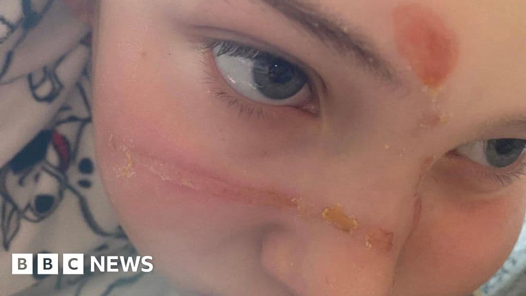 Squishy toy trend caused 'traumatising' burns
