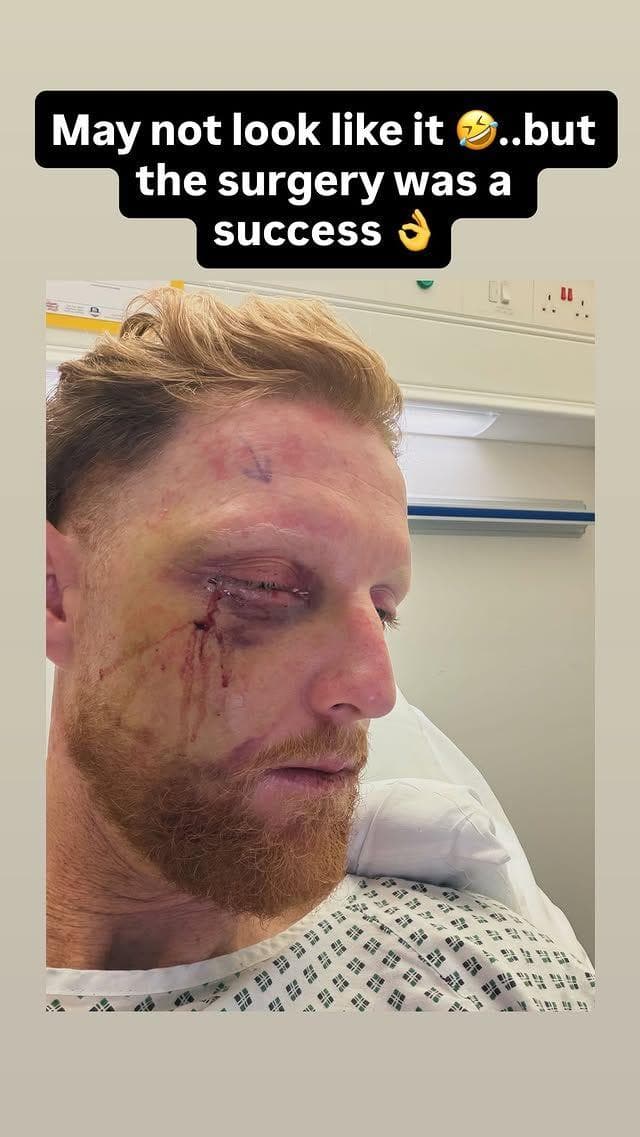 Ben Stokes' face after surgery